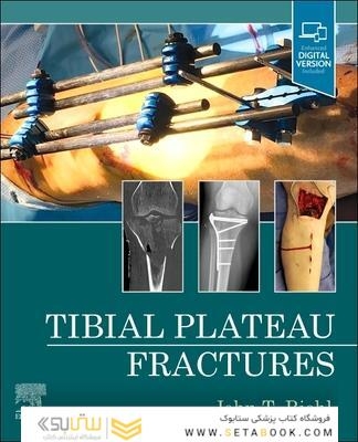 Tibial Plateau Fractures
