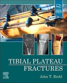 عکس Tibial Plateau Fractures