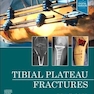 Tibial Plateau Fractures