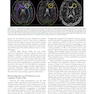 Nutrition and Lifestyle in Neurological Autoimmune Diseases : Multiple Sclerosis