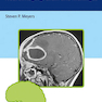 Differential Diagnosis in Neuroimaging: Brain and Meninges