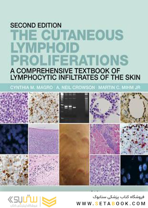 The Cutaneous Lymphoid Proliferations 