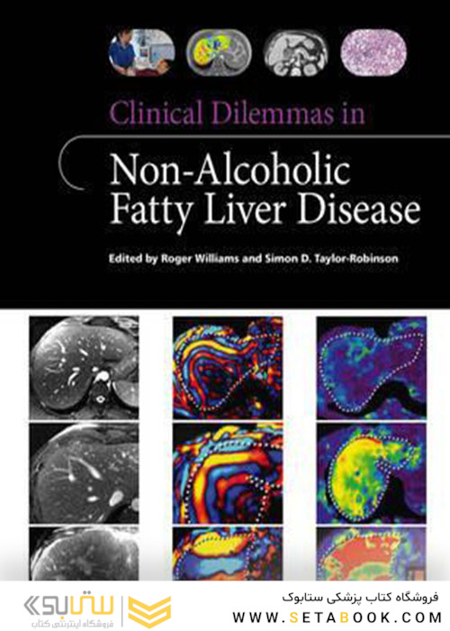 Clinical Dilemmas in Non-Alcoholic Fatty Liver Disease