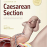 Textbook of Caesarean Section