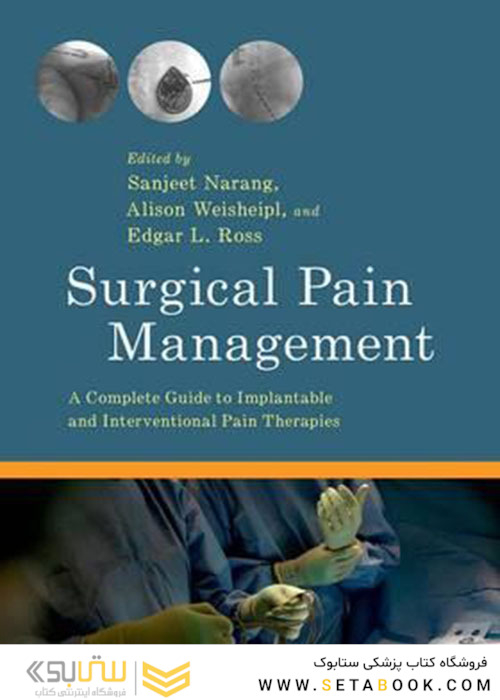 Surgical Pain Management : A Complete Guide to Implantable and Interventional Pain Therapies