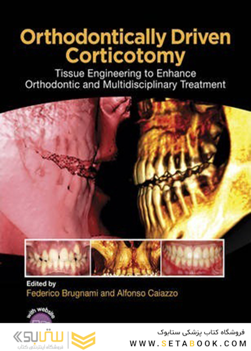 Orthodontically Driven Corticotomy