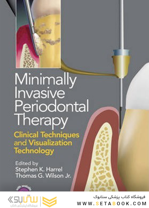 Minimally Invasive Periodontal Therapy : Clinical Techniques and Visualization Technology