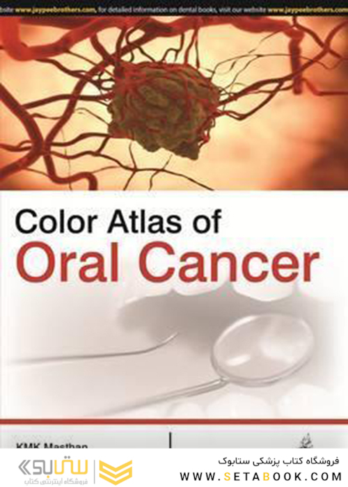 Color Atlas of Oral Cancer