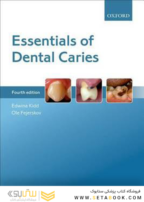 Essentials of Dental Caries