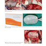 Bone Augmentation in Implant Dentistry: A Step-by-Step Guide to Predictable Alveolar Ridge and Sinus Grafting 1st Edition 2019  افزایش استخوان در دندانپزشکی ایمپلنت