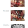 Bone Management in Dental Implantology 1st ed. 2019 Edition