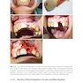 Bone Management in Dental Implantology 1st ed. 2019 Edition
