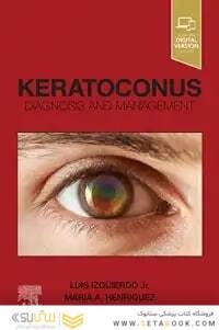 Keratoconus,E-Book: Diagnosis and Management