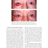 Facial Paralysis A Comprehensive Rehabilitative Approach