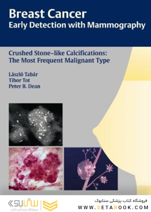 Breast Cancer: Early Detection with Mammography: Crushed Stone-like Calcifications: The Most Frequent Malignant Type 1st Edicion 2008
