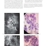 Breast Cancer: Early Detection with Mammography: Crushed Stone-like Calcifications: The Most Frequent Malignant Type 1st Edicion 2008