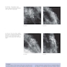 Breast Cancer: Early Detection with Mammography: Crushed Stone-like Calcifications: The Most Frequent Malignant Type 1st Edicion 2008