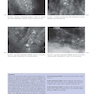 Breast Cancer: Early Detection with Mammography: Crushed Stone-like Calcifications: The Most Frequent Malignant Type 1st Edicion 2008