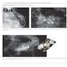 Breast Cancer: Early Detection with Mammography: Crushed Stone-like Calcifications: The Most Frequent Malignant Type 1st Edicion 2008