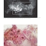 Breast Cancer: Early Detection with Mammography: Crushed Stone-like Calcifications: The Most Frequent Malignant Type 1st Edicion 2008