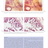Breast Cancer: Early Detection with Mammography: Crushed Stone-like Calcifications: The Most Frequent Malignant Type 1st Edicion 2008