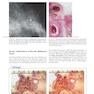 Breast Cancer: Early Detection with Mammography: Crushed Stone-like Calcifications: The Most Frequent Malignant Type 1st Edicion 2008