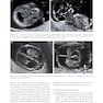 Ultrasound of Congenital Fetal Anomalies 2nd Edition2014