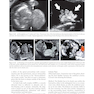 Ultrasound of Congenital Fetal Anomalies 2nd Edition2014