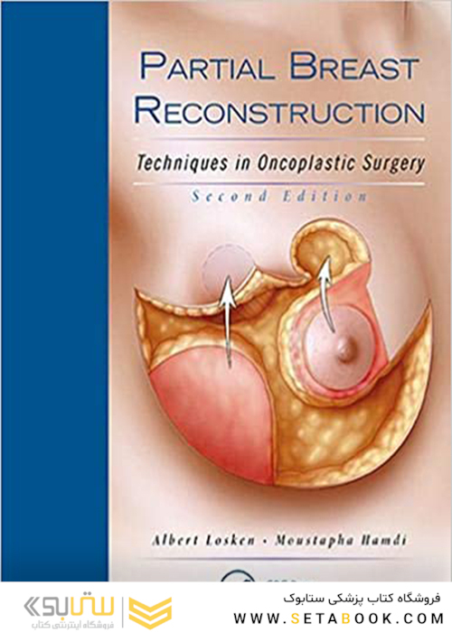 Partial Breast Reconstruction, 2nd Edition2017 بازسازی نسبی پستان