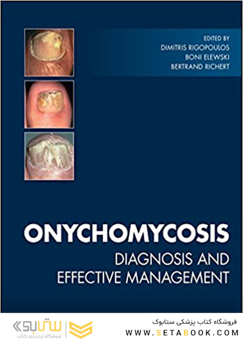 Onychomycosis: Diagnosis and Effective Management 1st Edition2018