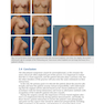 Breast Augmentation Video Atlas, 2nd Edition 2019