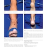 Foot and Ankle Sports Orthopaedics, 1st Edition2017