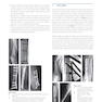 Osteoporotic Fracture Care: Medical and Surgical Management2018