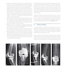 Osteoporotic Fracture Care: Medical and Surgical Management2018