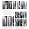 Osteoporotic Fracture Care: Medical and Surgical Management2018