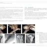 Osteoporotic Fracture Care: Medical and Surgical Management2018