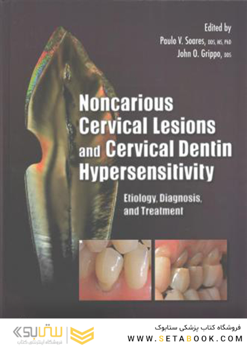 Noncarious Cervical Lesions and Cervical Dentin Hypersensitivity2017 ضایعات غیر سرطانی دهانه رحم و افزایش حساسیت عاج گردنی