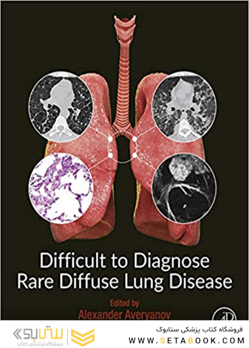 Difficult to Diagnose Rare Diffuse Lung Disease2019 تشخیص بیماری نادر ریوی