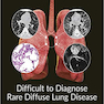 Difficult to Diagnose Rare Diffuse Lung Disease2019 تشخیص بیماری نادر ریوی
