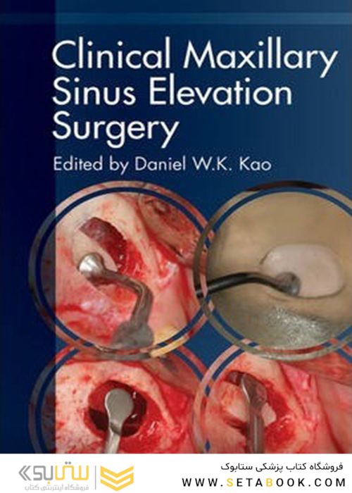 Clinical Maxillary Sinus Elevation Surgery 1st Edition2014 جراحی بالینی سینوس فک بالا