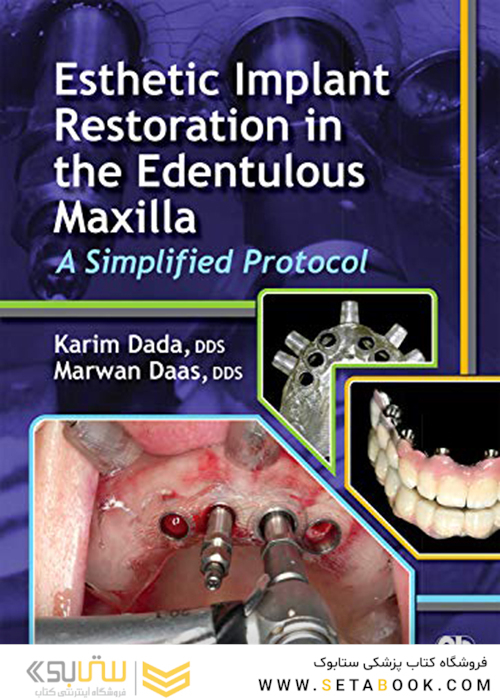 Esthetic Implant Restoration in the Edentulous Maxilla2014 ترمیم ایمپلنت زیبایی در فک بالا