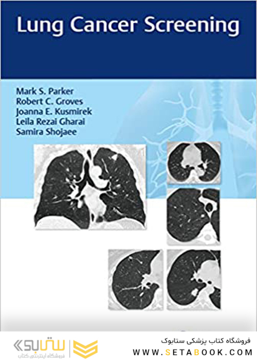 Lung Cancer Screening 1st Edition2017 غربالگری سرطان ریه