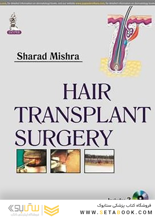 Hair Transplant Surgery 1st Edition 2014