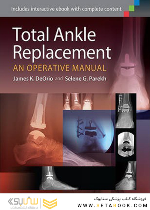 Total Ankle Replacement: An Operative Manual First Edition2014 تعویض کامل مچ پا: یک کتابچه راهنمای عملیاتی