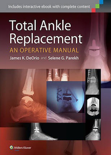 عکس Total Ankle Replacement: An Operative Manual First Edition2014 تعویض کامل مچ پا: یک کتابچه راهنمای عملیاتی