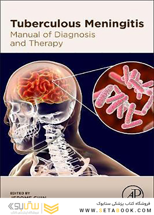 Tuberculous-Meningitis2020 مننژیت سل