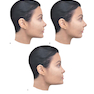 Dermal Fillers: Facial Anatomy and Injection Techniques2020
