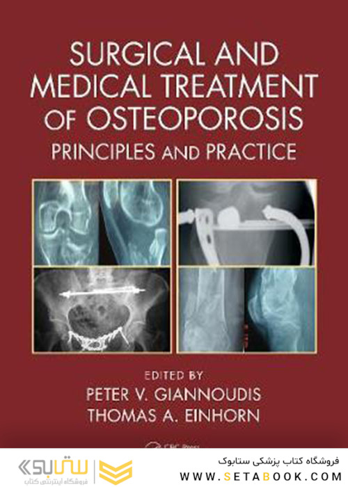 Surgical and Medical Treatment of Osteoporosis: Principles and Practice 1st Edition درمان جراحی و پزشکی پوکی استخوان: اصول و عمل