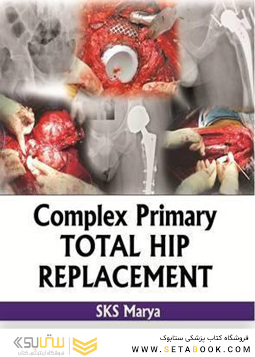 Complex Primary Total Hip Replacement 1st Edition