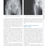 Complex Primary Total Hip Replacement 1st Edition